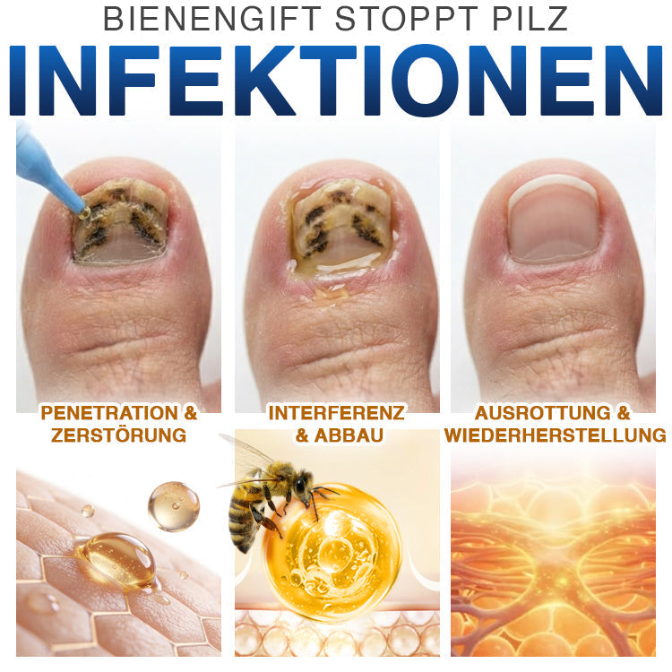 🇩🇪 CareBreeze® Fungi Free Bienengift-Nagelbehandlung ✨