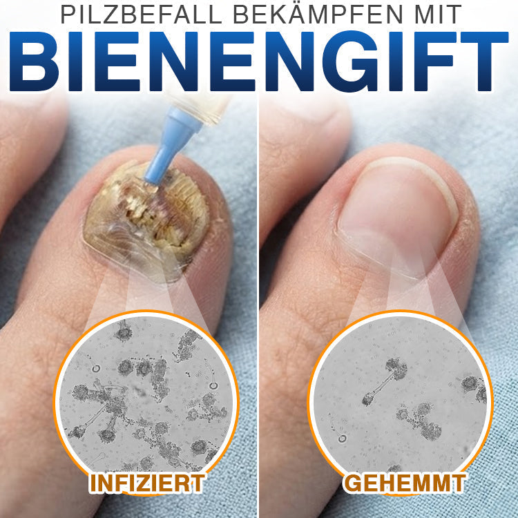 🇩🇪 CareBreeze® Fungi Free Bienengift-Nagelbehandlung ✨