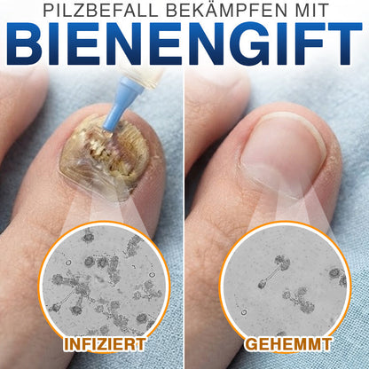 🇩🇪 CareBreeze® Fungi Free Bienengift-Nagelbehandlung ✨